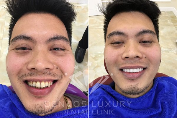 chi phí làm răng sứ 6