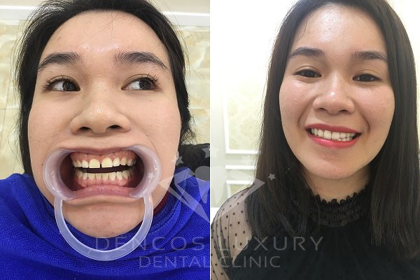 chi phí làm răng sứ 8