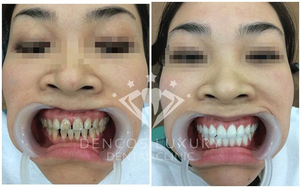 chi phí làm răng sứ 9