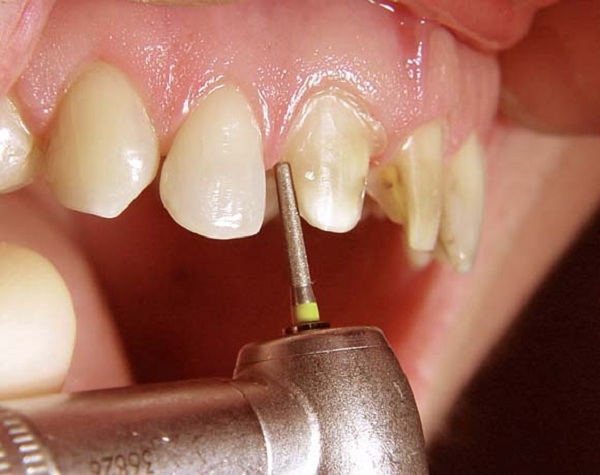 độ bền răng sứ cercon 4