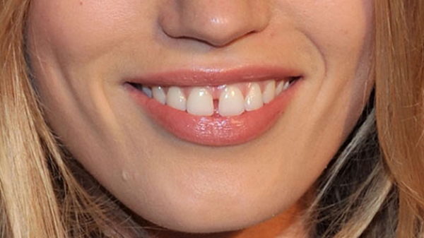 răng cửa bị thưa phải làm sao