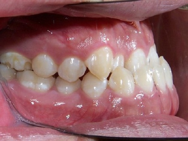 Răng móm có nên bọc sứ không