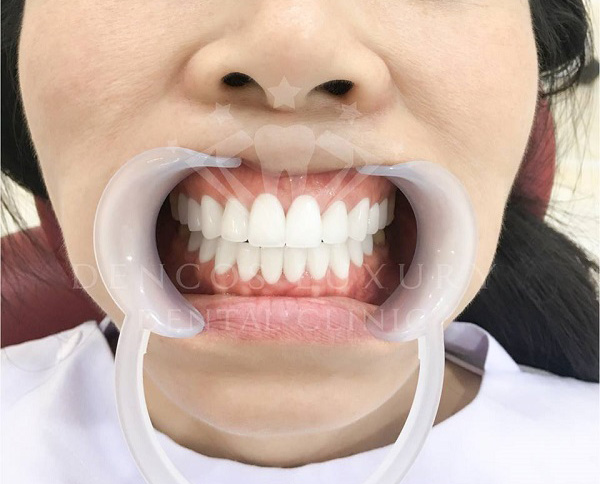 làm răng sứ có hại không 4