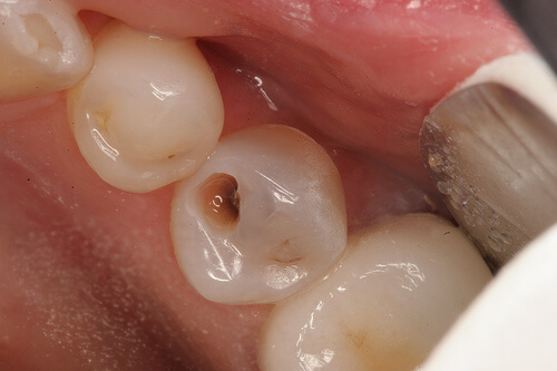 nhức răng sau khi bọc răng sứ 