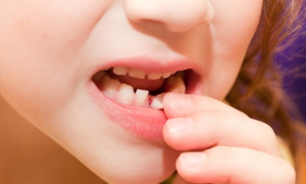 Nhổ răng cho trẻ em 2