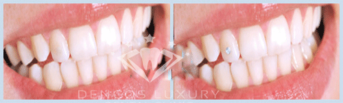 Răng đính kim cương 2