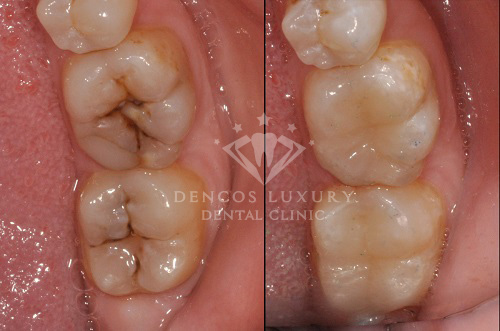 Răng sâu nên hàn trám Composite hay bọc răng sứ 2