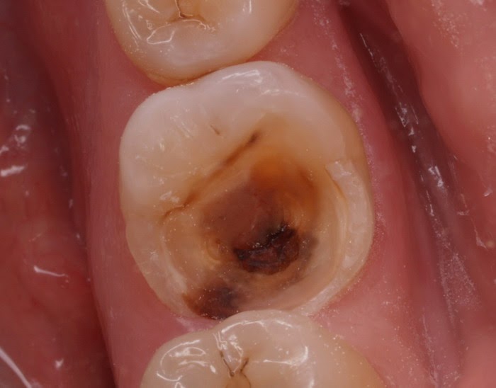 Răng sâu nên hàn trám Composite hay bọc răng sứ