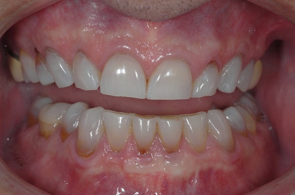 bệnh nghiến răng 3