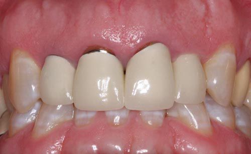 tìm hiểu về răng sứ titan 4