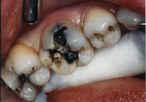 Cách chữa sâu răng