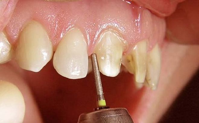 Bọc răng sứ có phải mài răng không?