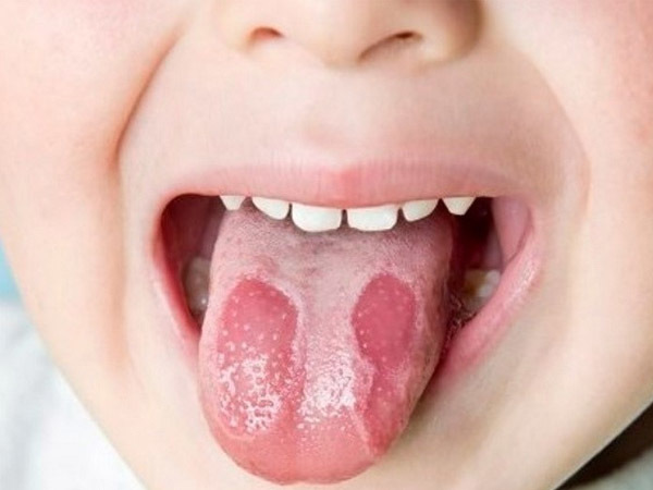 Miệng khô lưỡi trắng là bệnh gì?