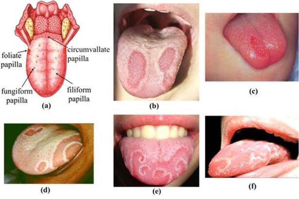 Miệng khô lưỡi trắng là bệnh gì?