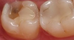 Bọc răng hàm khôi phục lại chức năng ăn nhai – Tại sao nên thực hiện