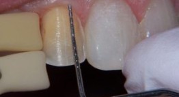 Bọc sứ răng thưa – Lựa chọn tối ưu cho hàm răng khít sát, đều đẹp