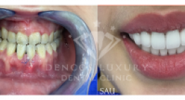 Dán Răng Sứ Thẩm Mỹ – Công nghệ dán sứ mặt răng Hiện Đại nhất năm