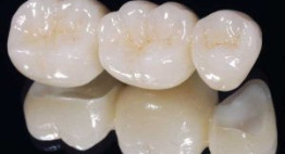 Răng sứ Cercon – Chuẩn mực về răng sứ, phù hợp với mọi đối tượng