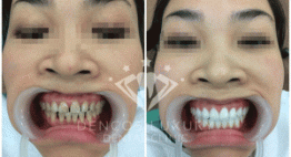 Bọc răng sứ thẩm mỹ 2in1 – Vĩnh biệt răng sứt mẻ, xấu hỏng