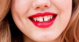 Chụp sứ răng thưa – Giải pháp cho nụ cười đẹp hoàn hảo