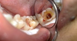 Bọc răng sứ cho răng sâu hiệu quả như thế nào?