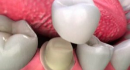 ⌈MÃO RĂNG SỨ⌉ – Tất tần tật thông tin cho bạn tìm hiểu