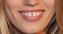 Răng thưa có nên bọc sứ? – Bác sĩ chuyên khoa sẽ trả lời cho bạn