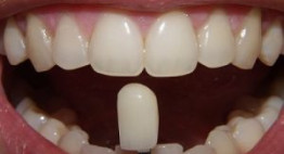 Chi phí bọc răng cửa của từng loại răng sứ hiện nay như thế nào?