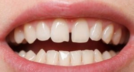 Chữa răng thưa chưa bao giờ đơn giản hơn với bọc răng sứ thẩm mỹ