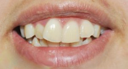 Mài nhỏ răng cửa & Phục hình răng như thế nào cho hiệu quả?