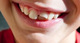 Phục hồi răng cửa bị mẻ cho hàm răng khỏe mạnh bền lâu