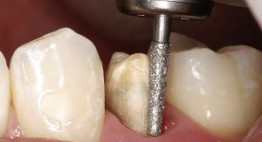 Quá trình mài răng như thế nào là đảm bảo nhất?