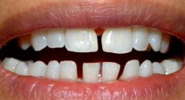 Những lý giải tại sao răng bị thưa gây SHOCK cho nhiều người