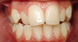 Lựa chọn giải pháp chỉnh 2 răng cửa bị vẩu hiệu quả chỉ trong 1 – 2 lần hẹn