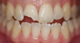 Bị sứt mẻ răng phải làm sao để răng nhanh chóng nguyên vẹn như ban đầu?