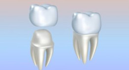 Bọc mão răng sứ là gì? Tổng hợp những thông tin chi tiết