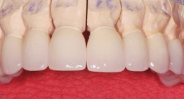 Chắc chắn bạn chưa biết thông tin cần thiết về bọc răng sứ Alumina
