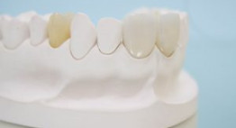 Những điểm cộng trong dịch vụ bọc răng sứ Cercon tại Dencos Luxury