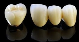 Răng sứ Titan có tốt không? Sự thật sẽ khiến bạn bất ngờ