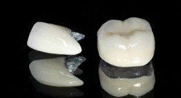 Chỉ với giá răng sứ Titan liệu có quyết định chất lượng, hiệu quả dịch vụ?