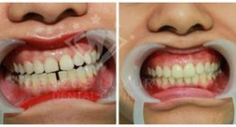 Răng thưa phải làm sao – chia sẻ của một người từng rất tự ti vì thưa răng