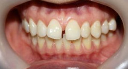 Nguyên nhân và cách giải quyết tình trạng răng cửa bị hở vĩnh viễn