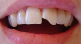 Răng bị mẻ  – Làm sao để răng có thể đẹp nguyên vẹn trở lại?