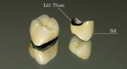 Có nên làm răng sứ Titan không – ý kiến từ chuyên gia