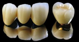Răng sứ titan sử dụng được bao lâu – chuyên gia tư vấn