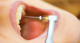 Chuyên gia giải đáp: Bọc răng sứ có phải lấy tủy không?