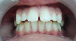 Chỉnh răng hô hiệu quả – nhanh chóng với bọc răng sứ thẩm mỹ