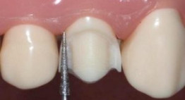 Mài răng hô bọc sứ – Nhanh chóng để có hàm răng đều đẹp tự nhiên