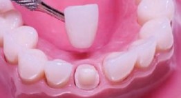 Tác dụng của bọc răng sứ không ai có thể phủ nhận