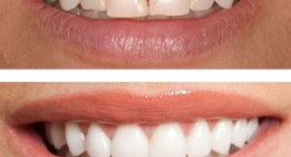 Bọc răng sứ cho răng cửa hô có phải là lựa chọn hợp lý?